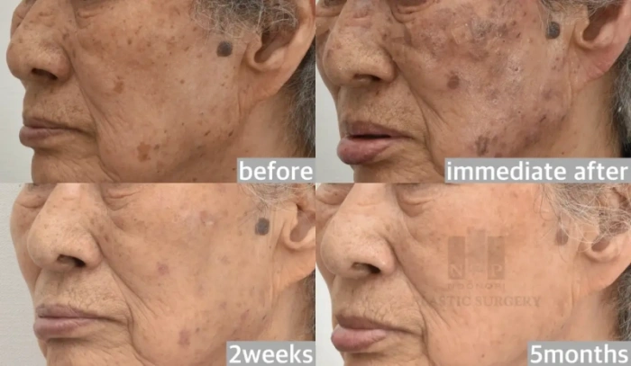 جلسة واحدة فقط من علاج Forever Young BBL القوي