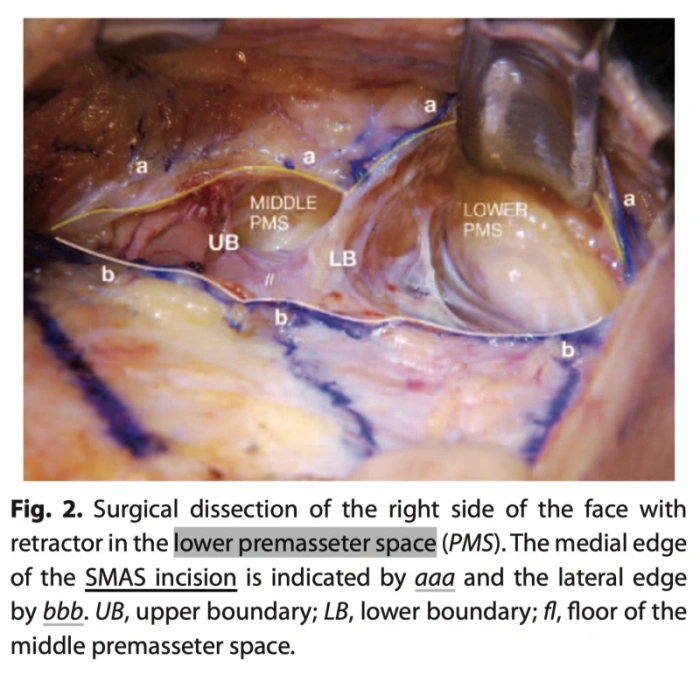术中SMAS下分离观察 (参考链接)
