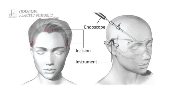 Illustration of the Endoscopic Forehead Lift principle - lifting the brow and tissue from the bone