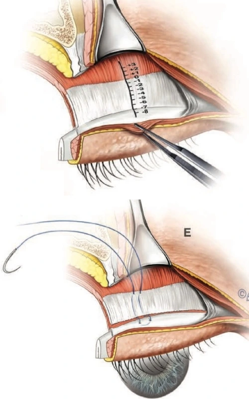 睡眼治疗示意图