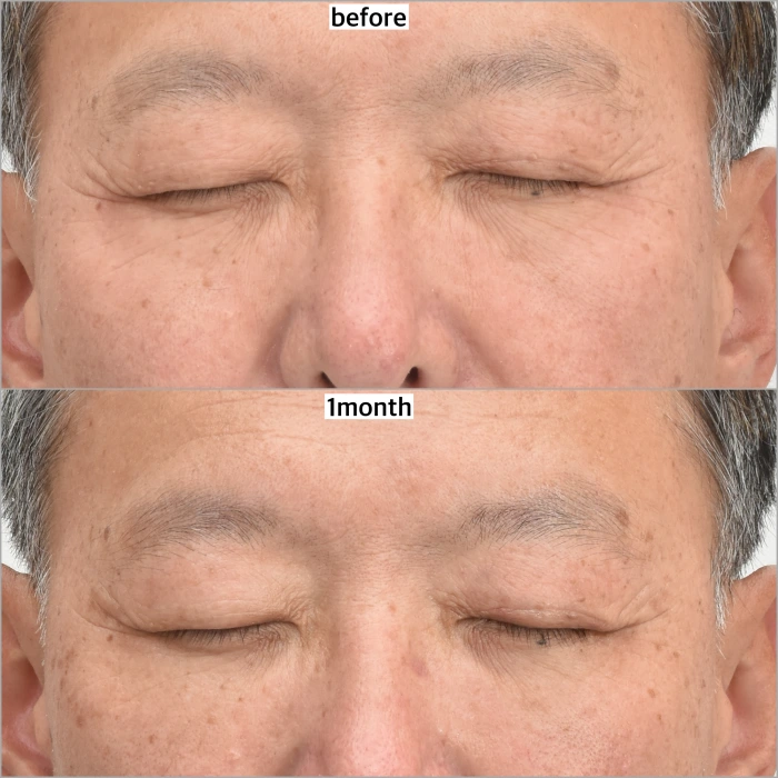 مزيج من جراحة الأكياس تحت العينين وتقشير الجلد بالليزر العميق، شهر واحد