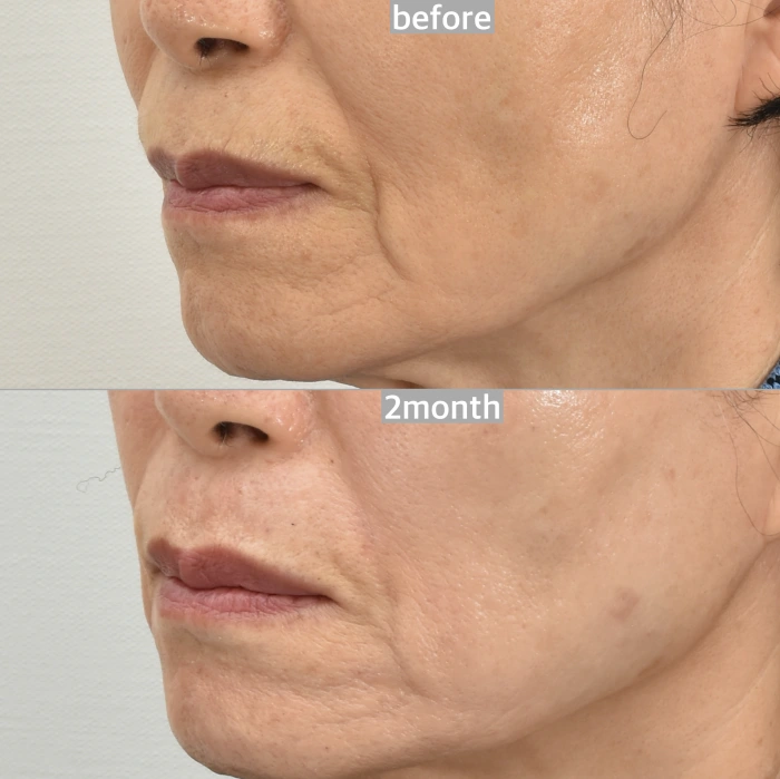 قبل وبعد إعادة تسطيح البشرة بالليزر في Noonopi Plastic Surgery Korea