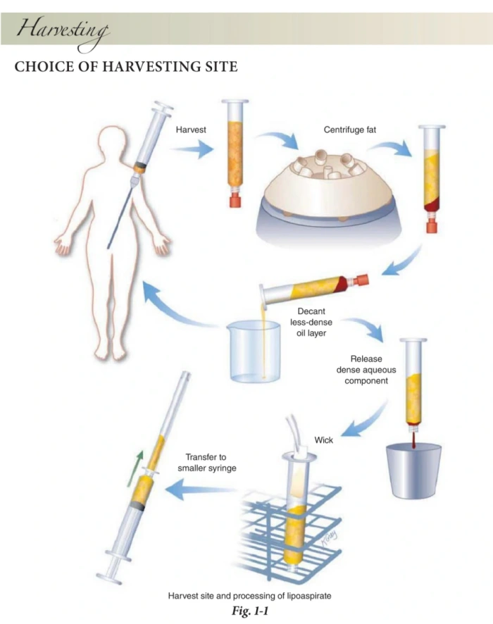عملية معالجة الدهون لحقنها (كتاب مرجعي)