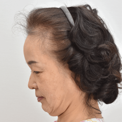 侧面俯视图清晰展现深层颈部提升术的卓越效果