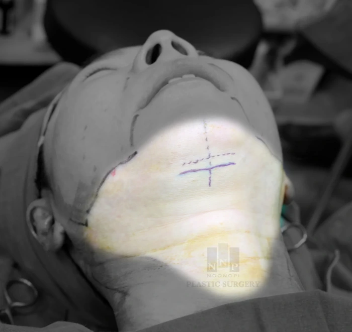 Mini neck lift incision and dissection area