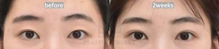 매몰 쌍꺼풀 2주 후