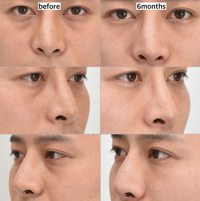 lower lid fat repositioning before after