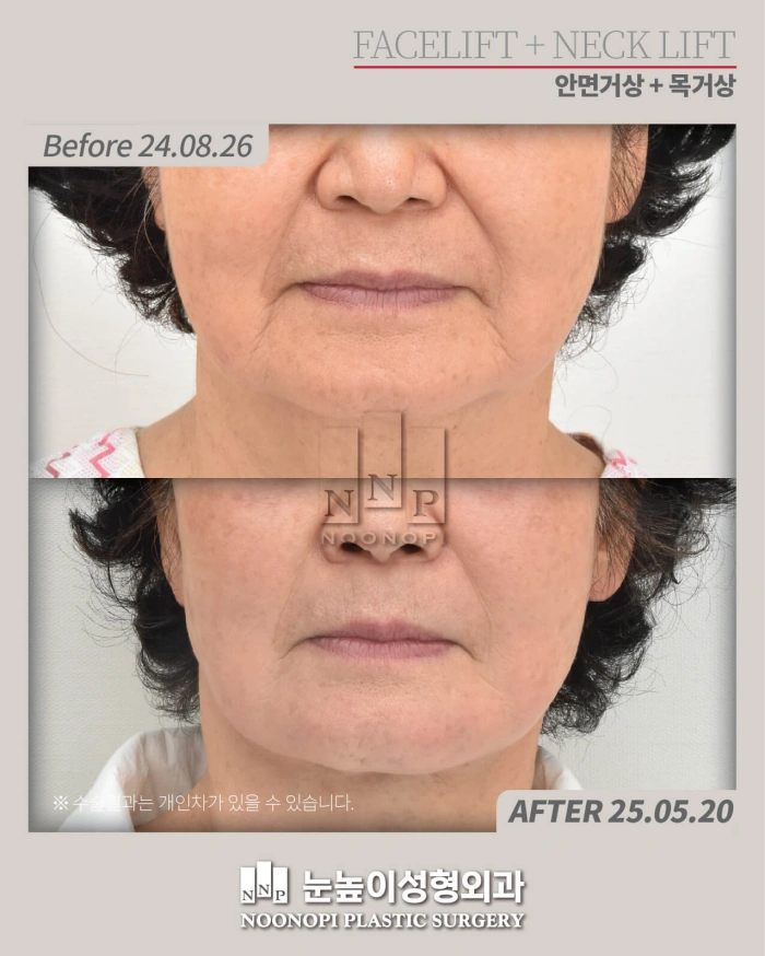 facelift results photo by Dr Park, Korean plastic surgeon