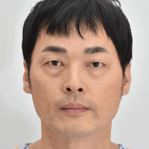 눈밑지방재배치 1주 뒤 모습