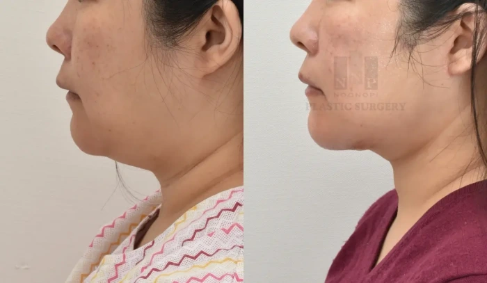 30余岁患者面颈部联合提升术