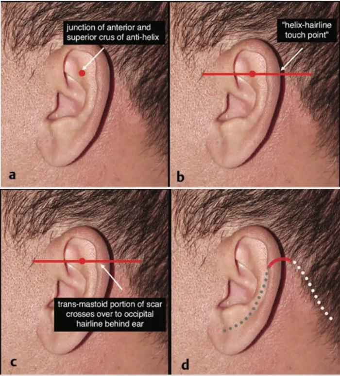 incision placement in facelift