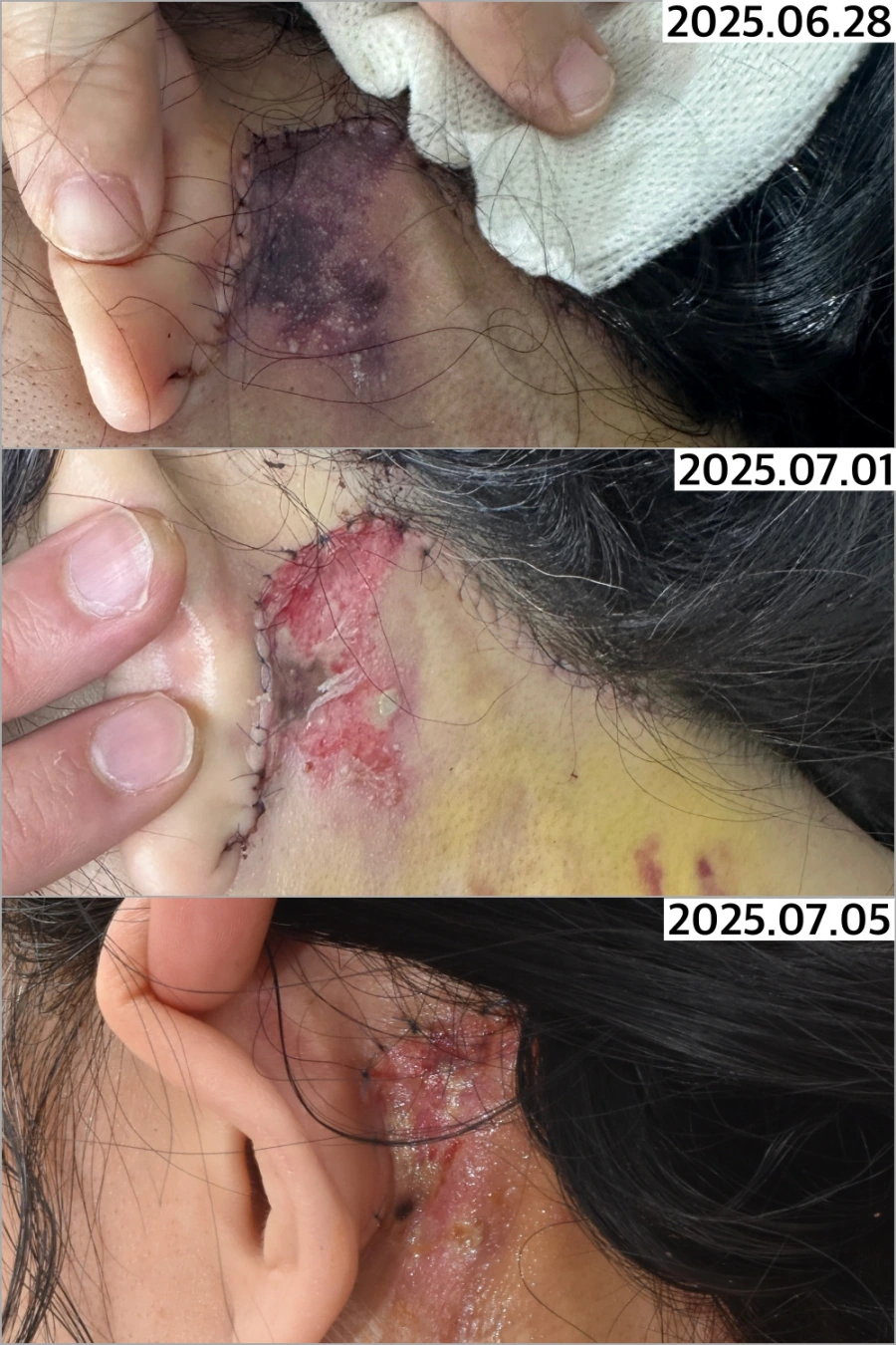 피부괴사 고압산소치료