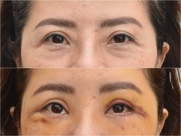 Endotine brow lift with lower blepharoplasty, 9 days post-op