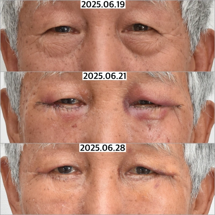 بعد 11 يومًا من إجراء جراحة تجميل الجفن السفلي لمريض يبلغ من العمر 79 عامًا
