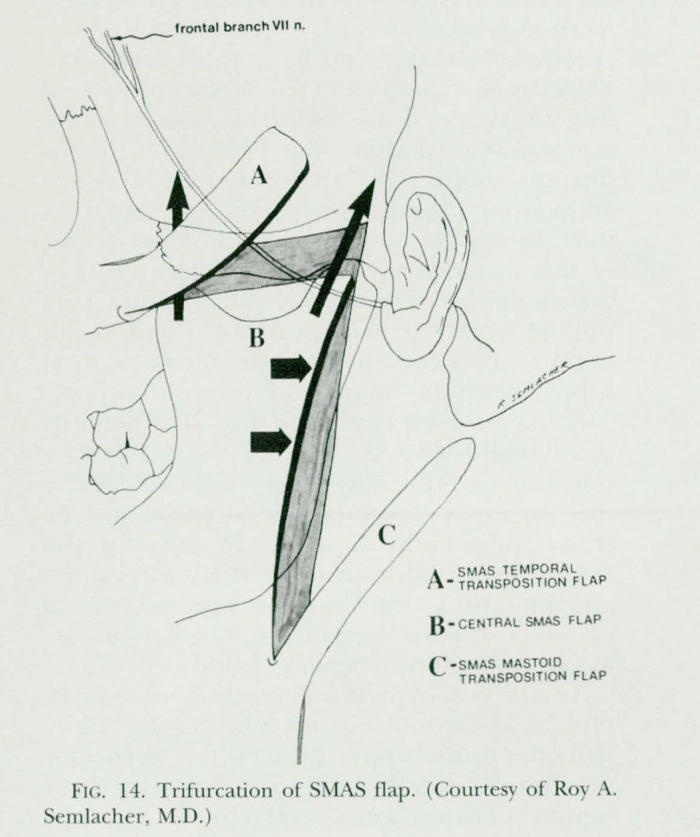 For secure fixation, the SMAS can be divided into several pieces and sutured