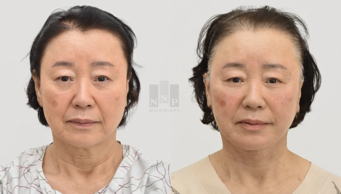 눈높이성형외과 듀얼플레인 안면거상 전후