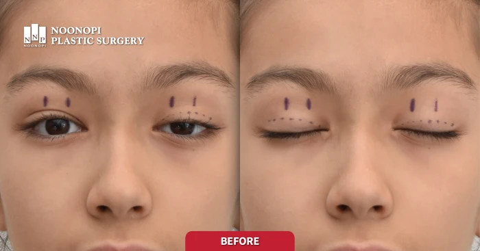 12-year-old patient with severe congenital ptosis in the left eye
