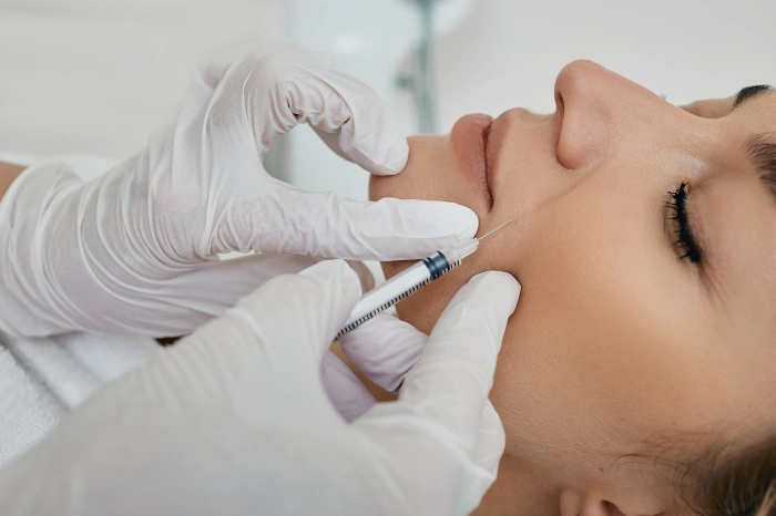 smile line fillers