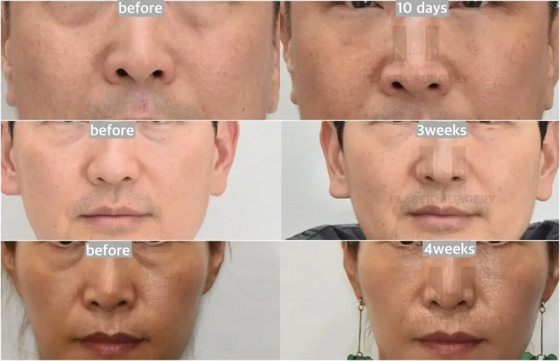 eyebags removal korea