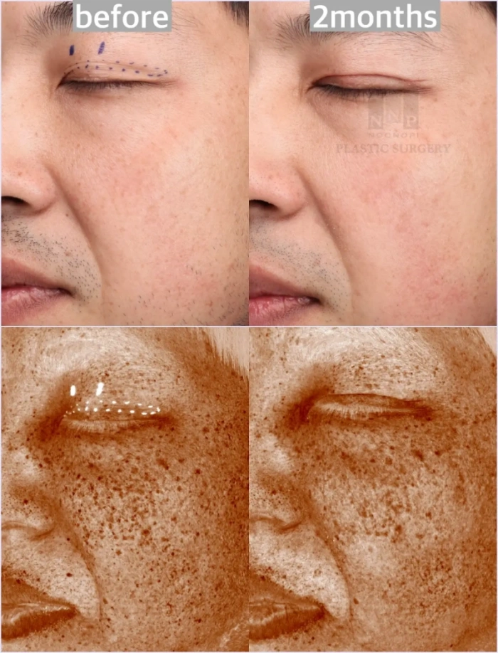 BBL laser before after Korea