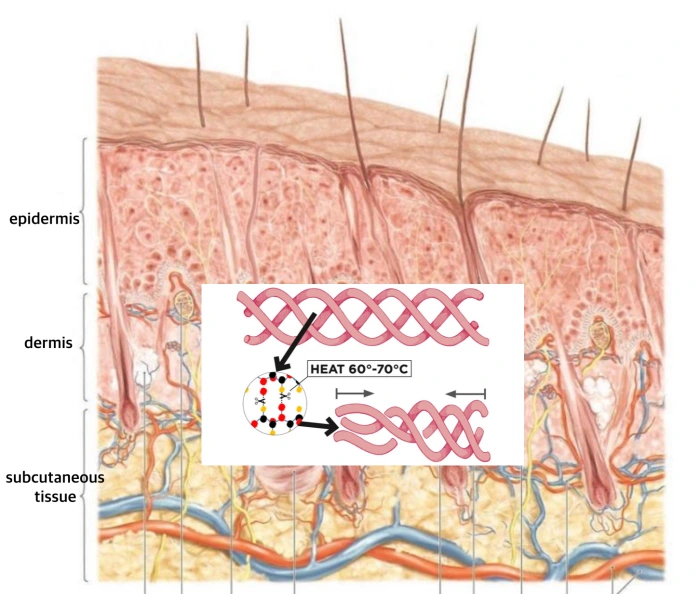 适度热量是刺激胶原再生的必要条件