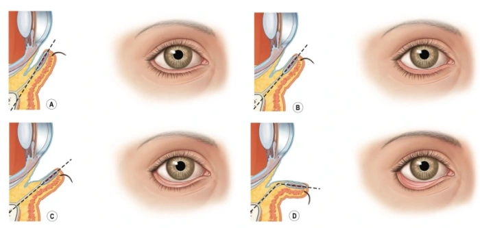 أعراض انكماش الجفن السفلي بعد جراحة تجميل الجفن