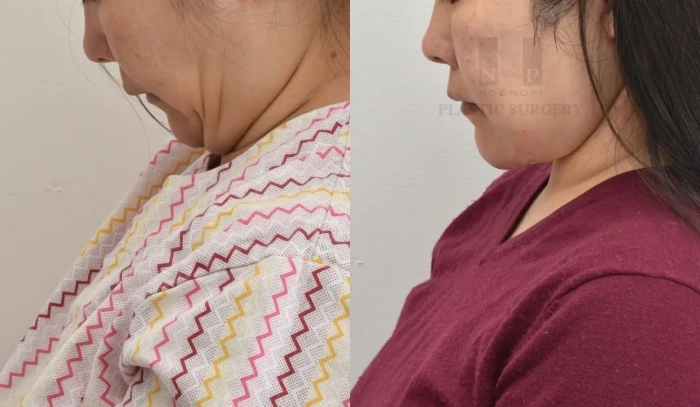 三十余岁患者面颈部联合提升术