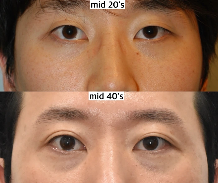 眼周老化历程：二十岁时光滑紧致，四十岁时已现明显凹陷。