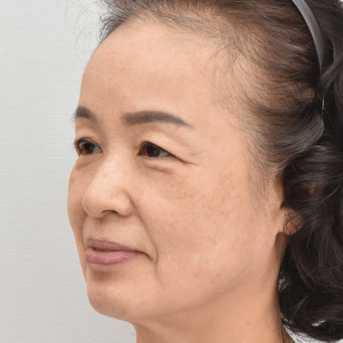 鼻唇沟与下颌线已得到良好改善（术后3个月）