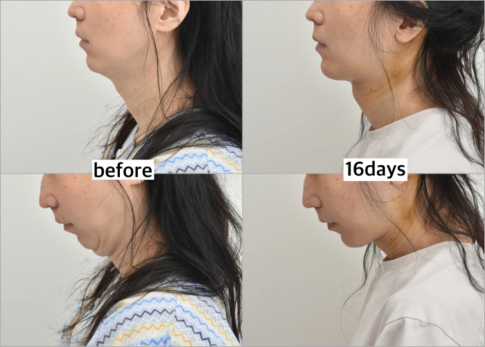 Neck wattles gone after full neck lift — 16 days post-op