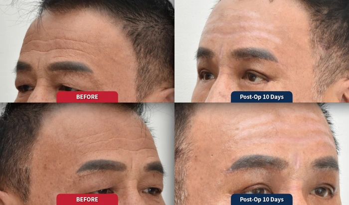Early-stage PIH occasionally seen in Asian skin
