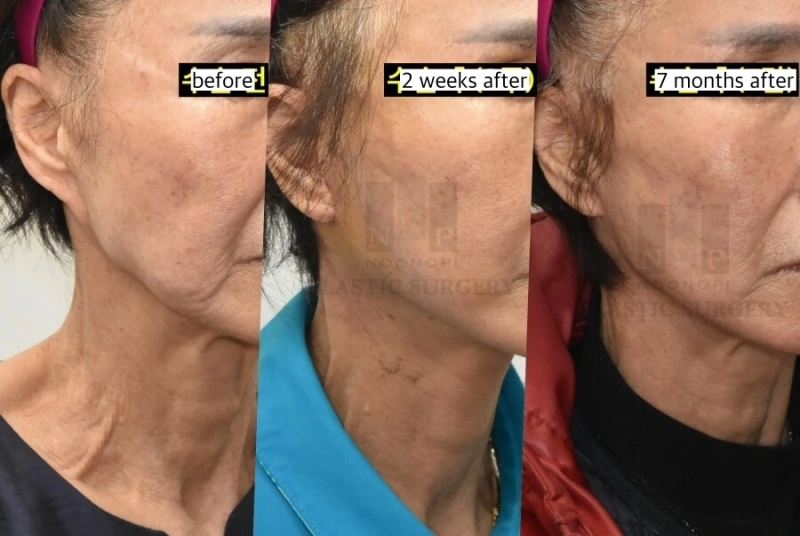 تصحيح الأذن الصغيرة بعد عملية شد الوجه الرابعة