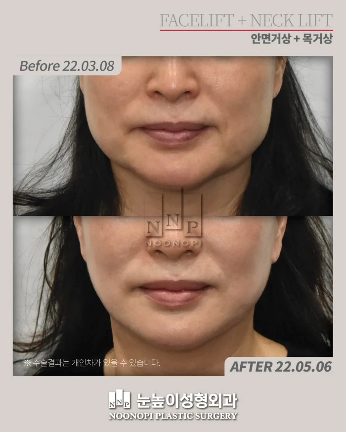 photo of asian facelift results at noonopi plastic surgery korea