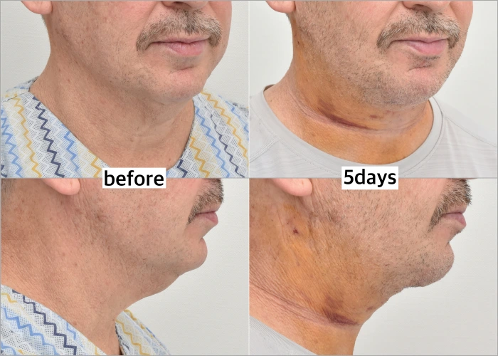 Neck Lift Before and After Photo of Patient in His 50s
