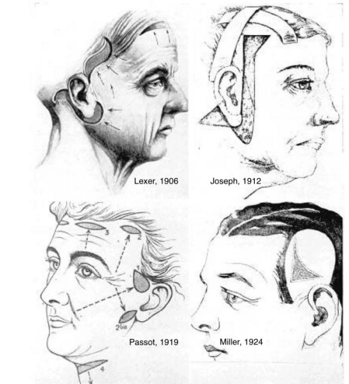 ”الشد المصغر“، تجعد قديم في شد الوجه