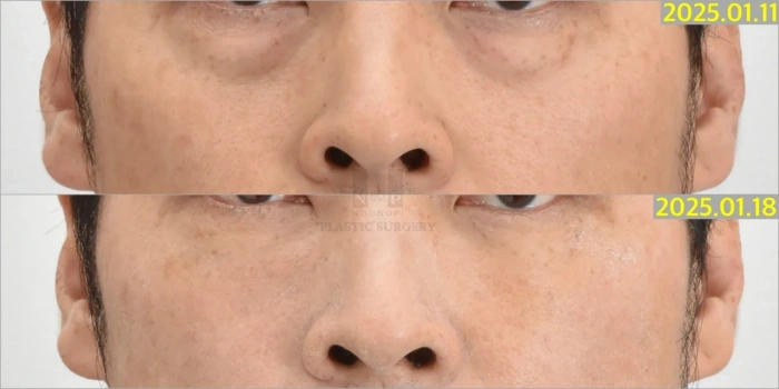 韩国经结膜下眼睑整形术