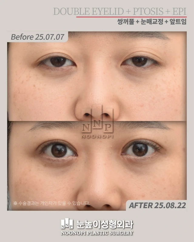 A person with ptosis, also known as sleepy eyelids or droopy eyelids, before and after
