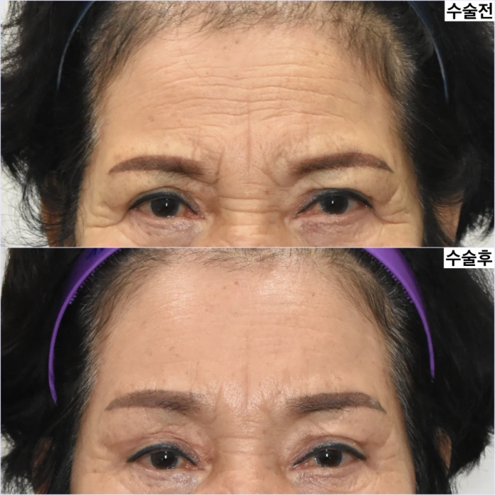 forehead wrinkle before after