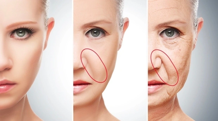 cause of nasolabial folds