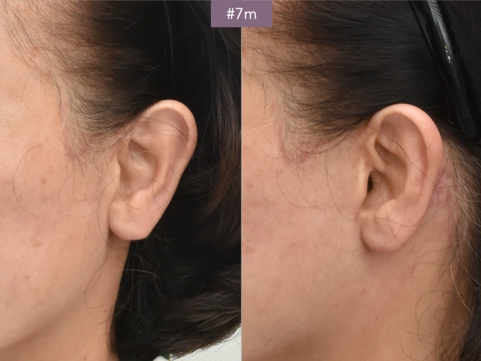 ear shape after facelift