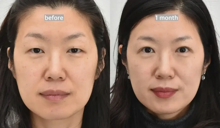 عملية تجميل الجفن العلوي قبل وبعد