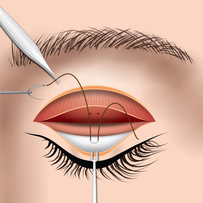 إدخال الخيط في إبرة فارغة