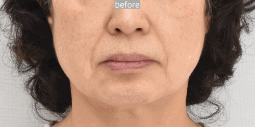 why face and neck lift should be combined at the sametime