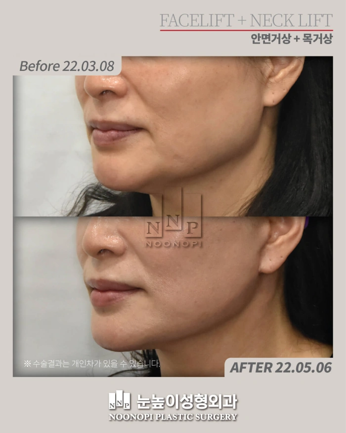 SMAS facelift