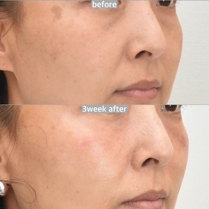 epidermal pigment treatment