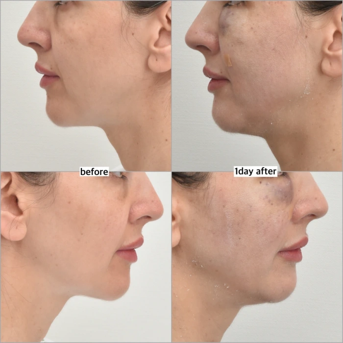 بعد يوم واحد من زراعة الدهون تحت العين