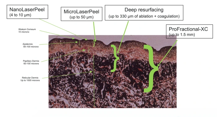 Sciton skin peeling laser