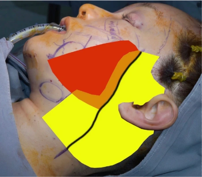 深平面拉皮手术的分离区域