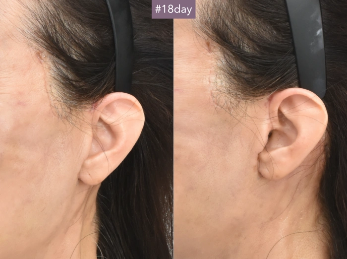 ear scar after facelift