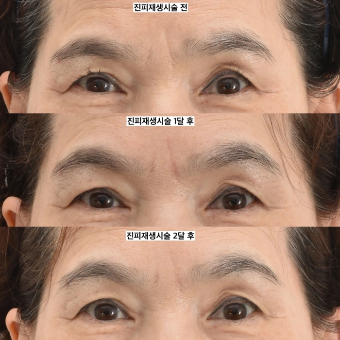 眉间纹真皮填充注射术后1个月与2个月对比